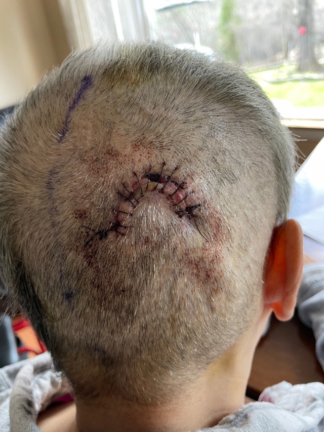 Close-up of a scalp showing stitches in a curved pattern on the back of a head, post-surgery.